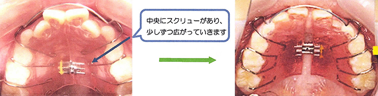 ＜ 拡大床装置 (顎を広げてデコボコを治します) ＞