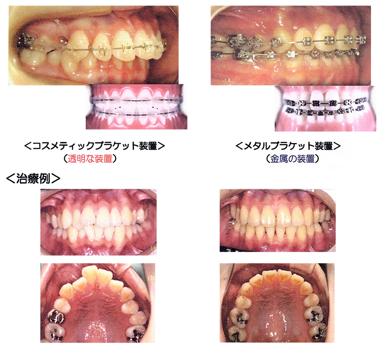 ブラケット装置（歯の表側につける装置）