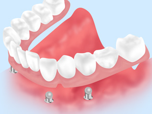インプラントオーバーデンチャー