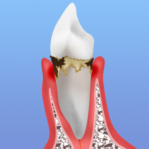 中期歯周炎