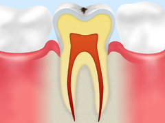 ［CO：　ごく初期の虫歯］
