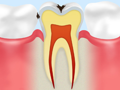 ［C1：　エナメル質の虫歯］