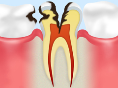 ［C3：　神経に達した虫歯］