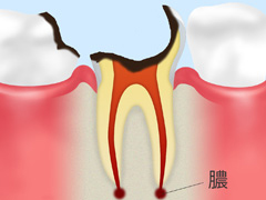 ［C4：　歯根に達した虫歯］